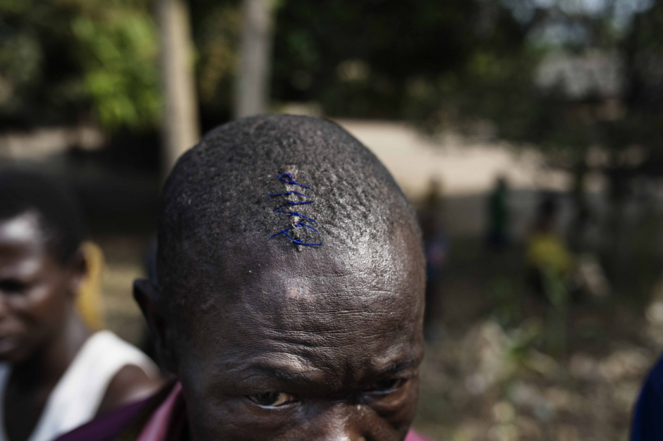 Central African Republic, 17 January 2014On the road from Bangui to Bouali, a young man shows the scar of a machete blow he received from pro-Seleka militiamen.République Centrafricaine, 17 Janvier 2014Sur la route reliant Bangui à Bouali, un jeune homme montre la cicatrice d'un coup de machette reçu selon lui par des milices pro-Seleka.Michael Zumstein / Agence VU
